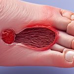 how diabetes affects wound healing